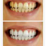 Unveiling the Power of Natural Teeth Whitener: A Comprehensive Guide